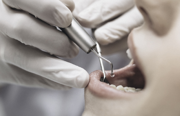 Tratamiento de periodoncia