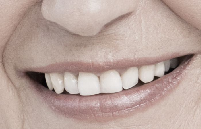 Tratamiento de prótesis dentales