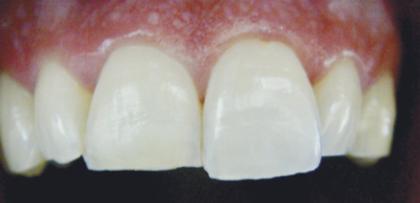 Casos clínicos carillas dentales foto antes