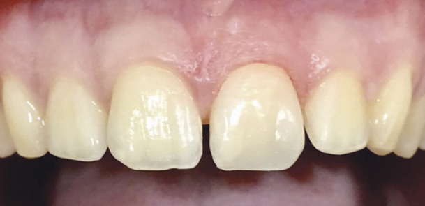 Casos clínicos carillas dentales reconstrucción después