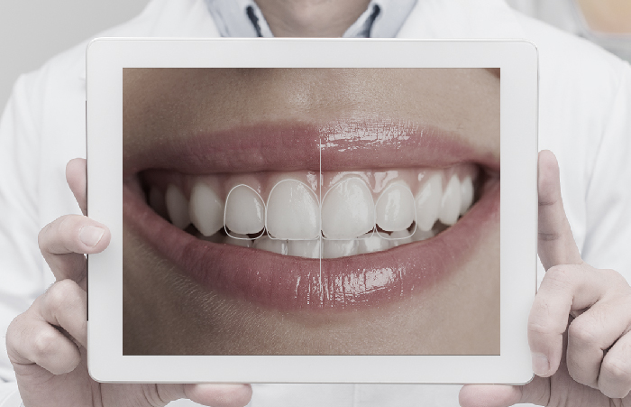 Tratamiento de digital smile design